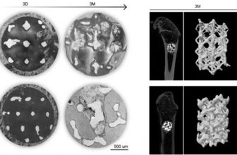 3D-gedrucktes Zinkgerüst könnte Knochendefektproblem lösen
